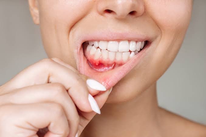Gum Diseases Treatment